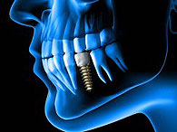 Sinus Lift in Poliklinik Adriatic-Dent  in Rovinj
